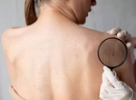 Un medicament anti-paraziți ar putea lupta împotriva unei forme agresive de cancer de piele. Ce arată ultimele studii