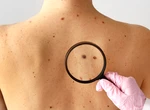 Două semne care nu dor, dar pot însemna cancer de piele. Ce spun specialiștii