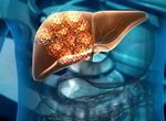 Simptome timpurii ale cancerului hepatic. Semnale de alarmă pe care nu trebuie să le treci cu vederea