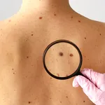 Două semne care nu dor, dar pot însemna cancer de piele. Ce spun specialiștii