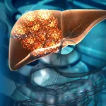 Simptome timpurii ale cancerului hepatic. Semnale de alarmă pe care nu trebuie să le treci cu vederea