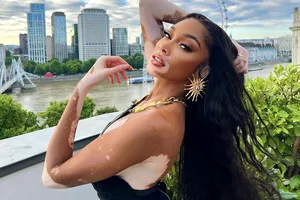 Povestea de succes a fetei bolnave de vitiligo care a devenit fotomodel internațional. Râdeau de ea, în adolescență, din cauza pielii ei