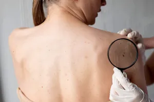Un medicament anti-paraziți ar putea lupta împotriva unei forme agresive de cancer de piele. Ce arată ultimele studii