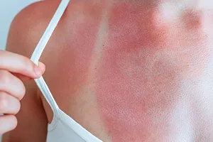 Cum te ferești de arsurile de vară și ce să faci dacă apar. Sfaturi utile pentru o vacanță fără incidente