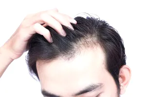 Căderea părului la bărbați: care sunt principalele cauze. Sfaturi pentru a menține un păr sănătos