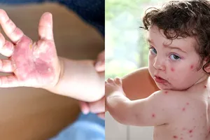 Noua boală care amenință lumea, după variola maimuței. Gripa care se răspândește masiv în India