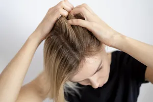 Ingredientul din bucătărie care te scapă de mătreață. Ce ar trebui să pui în șampon