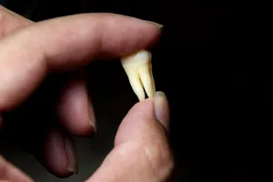 Ce înseamnă când visezi că îți cad dinții. Boala pe care o poate ascunde acest vis, de fapt