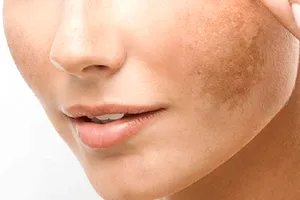 Patru ingrediente din bucătărie care te scapă de petele pigmentare. Cele mai simple și ieftine soluții pe care merită să le încerci
