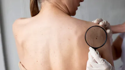 Un medicament anti-paraziți ar putea lupta împotriva unei forme agresive de cancer de piele. Ce arată ultimele studii