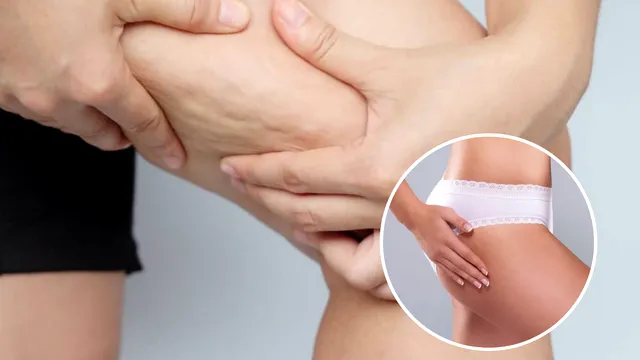 Patru pași simpli pentru a diminua celulita și tratamente care pot ajuta