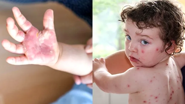 Noua boală care amenință lumea, după variola maimuței. Gripa care se răspândește masiv în India