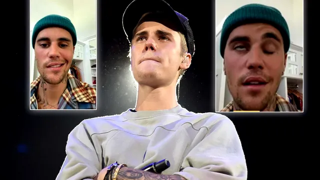 Ramsay Hunt, sindromul de care suferă Justin Bieber. Ce este și cum se poate trata. I-a provocat artistului paralizie facială