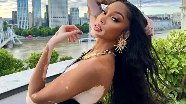 Povestea de succes a fetei bolnave de vitiligo care a devenit fotomodel internațional. Râdeau de ea, în adolescență, din cauza pielii ei