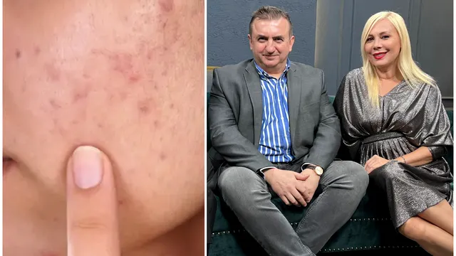 Cum scapi de cicatricile și semnele post-acneice? Dr. Irinel Nedelcu: ”Descuamare severă a pielii” VIDEO EXCLUSIV