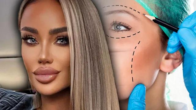 Cum se afișează Bianca Drăgușanu, după ce și-a făcut o nouă intervenție: ”Am ales să port cagulă. Sunt foarte inflamată și foarte vânătă” FOTO
