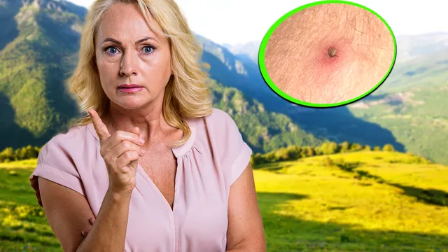 Ce să faci dacă te-a mușcat o căpușă. Primul lucru la care trebuie să fii atent