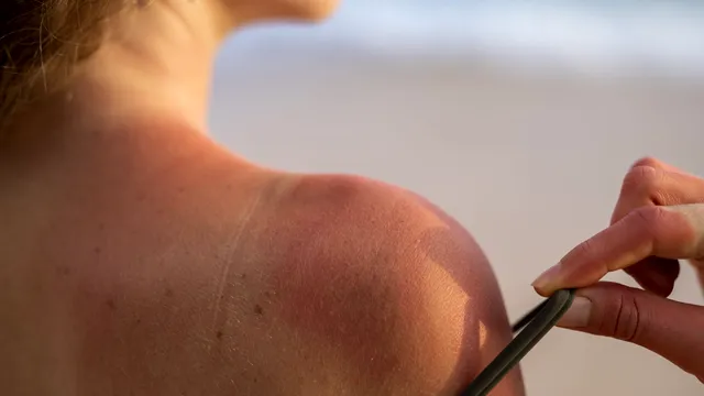 Remedii naturale împotriva arsurilor solare. Ce să faci dacă ai stat la plajă prea mult