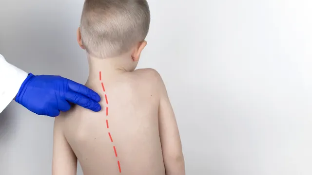 Scolioza la copii. Semne, diagnostic și cele mai bune metode de tratament