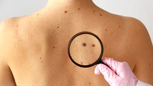 Două semne care nu dor, dar pot însemna cancer de piele. Ce spun specialiștii