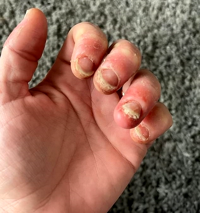Ce a pățit o femeie, după ce și-a făcut ani buni manichiura cu gel. Diagnosticul sever primit de la medic, imaginile sunt șocante