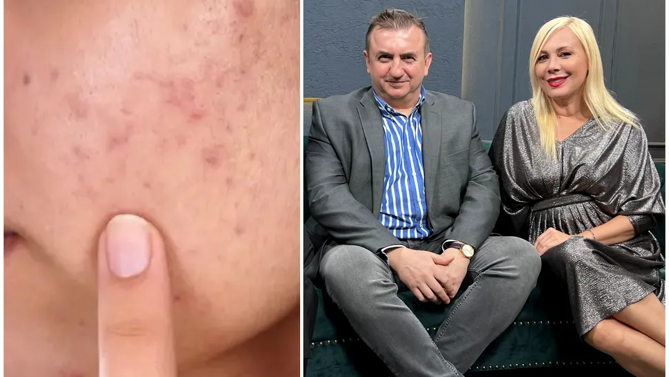 Cum scapi de cicatricile și semnele post-acneice? Dr. Irinel Nedelcu: ”Descuamare severă a pielii” VIDEO EXCLUSIV