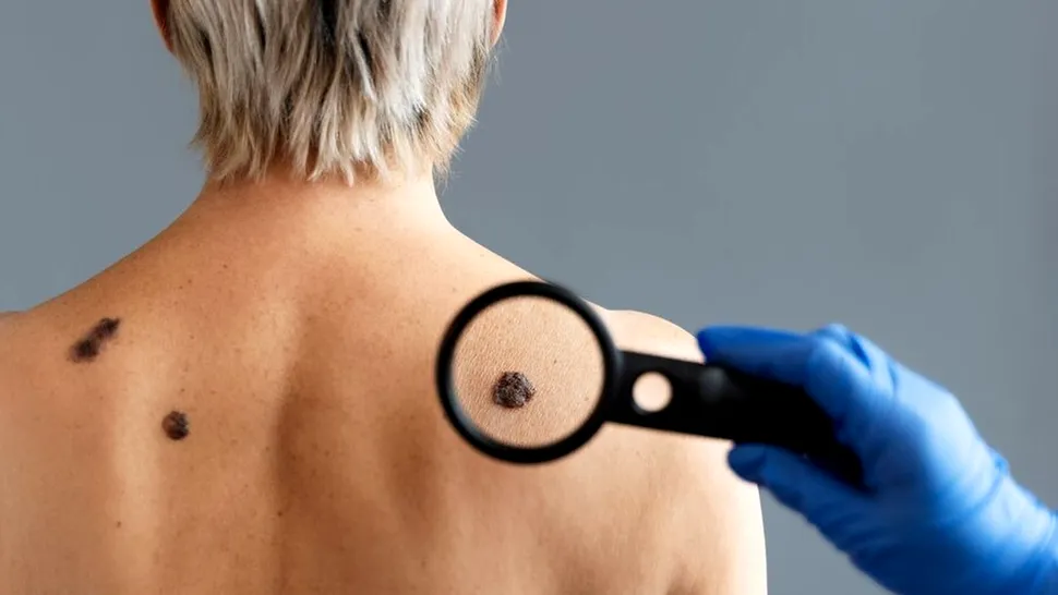 Îngrijirea pielii după 45 de ani. Cum să previi problemele dermatologice și riscul de cancer?