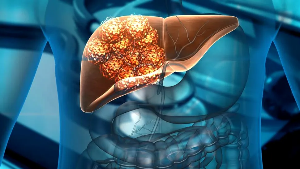 Simptome timpurii ale cancerului hepatic. Semnale de alarmă pe care nu trebuie să le treci cu vederea